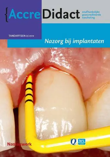 Nazorg bij implantaten / Druk 1 Favoriet