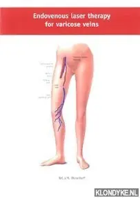 Exclusieve Aanbieding Endovenous laser therapy for varicose veins - B.C.V.M. Disselhoff